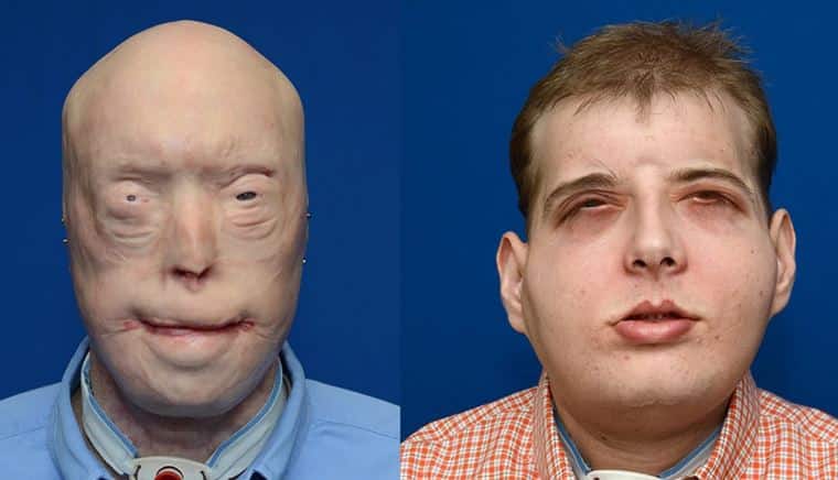 Firefighter Has Face Transplant After Third-Degree Burns And Survives Against All Odds – See Him Now, 7 Years Later