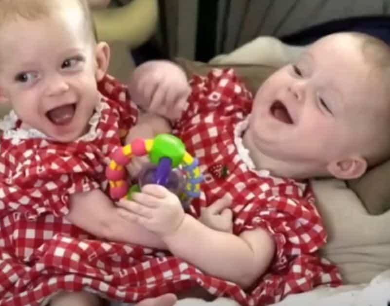 25 Years Later: The Astonishing Life of Conjoined Twins Separated in a 31-Hour Operation