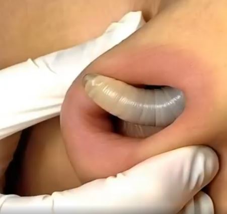 Larvae found in a young woman…