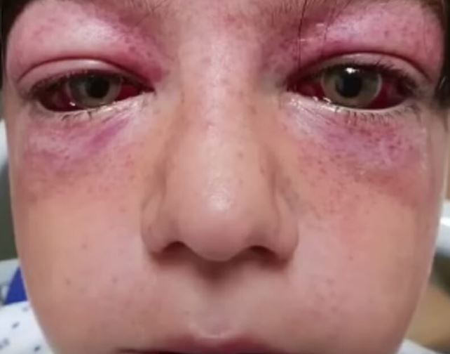 Playground craze leaves 11-year-old boy “looking like an alien” – mom issues warning for parents