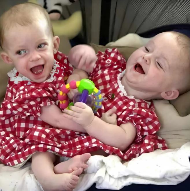 The conjoined twins joined at the chest were separated thanks to doctors — here is how they look 25 years later