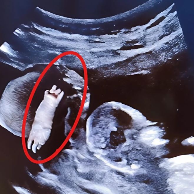 During the ultrasound, we saw something on the screen during the pregnancy that shocked us, here is what it really was