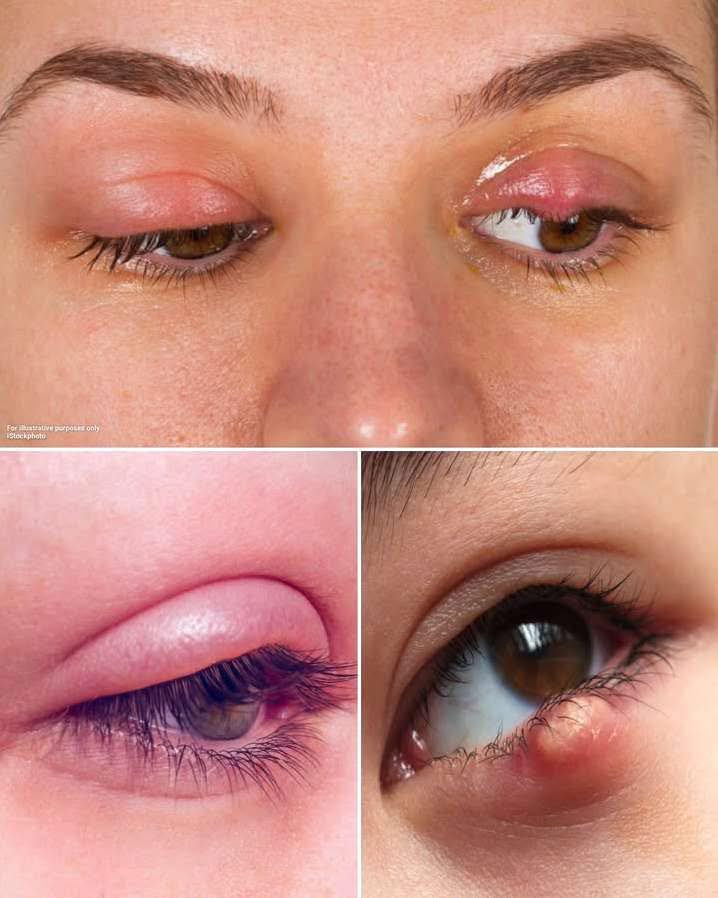 What Causes a Stye? Risks, How You Can Treat