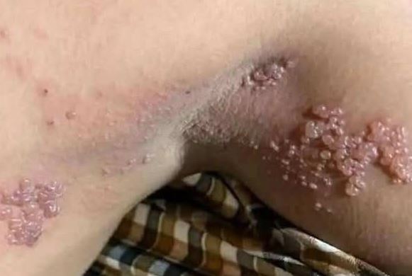 Genital Skin Changes: When to Worry and When to Relax