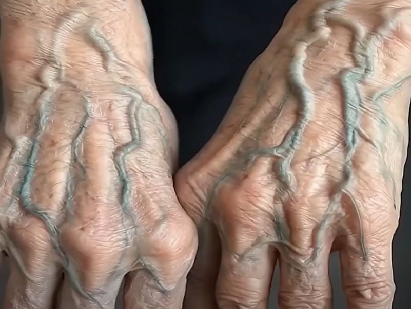 If your veins are visible in your hand, it is a signal of ca…