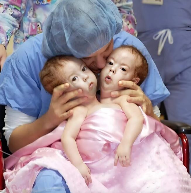 Born together, miraculously separated, the incredible fate of these Siamese twins. Here is how they live now