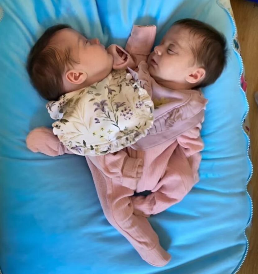 Thanks to the doctors, the Siamese twins were separated, and here’s what they look like 3 years later: children who move and inspire everyone.“