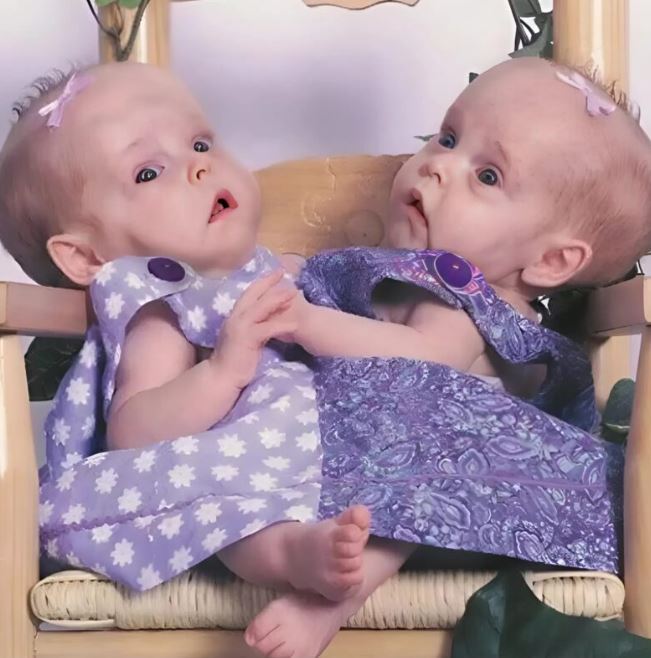 These Siamese twins were separated 18 years ago, and everyone was convinced they would not survive. Here is what the sisters look like today.
