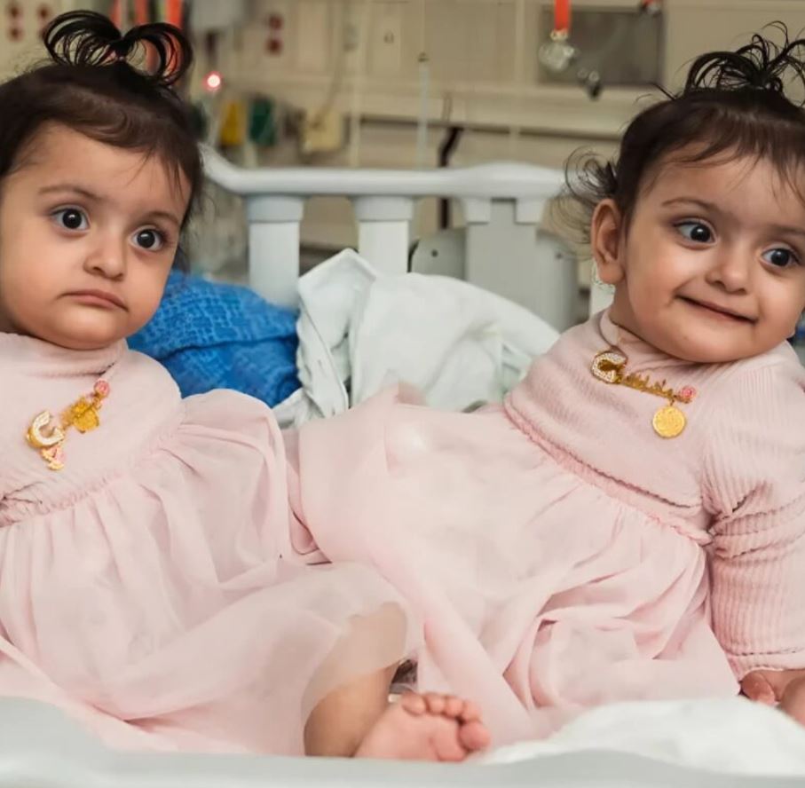 Conjoined twins successfully separated after an 18-hour surgery, here is how they look today