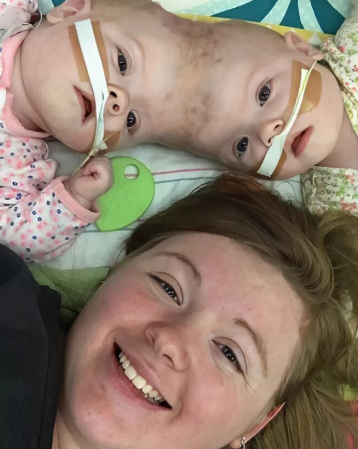 Conjoined twins successfully separated, graduate from kindergarten despite medical challenges