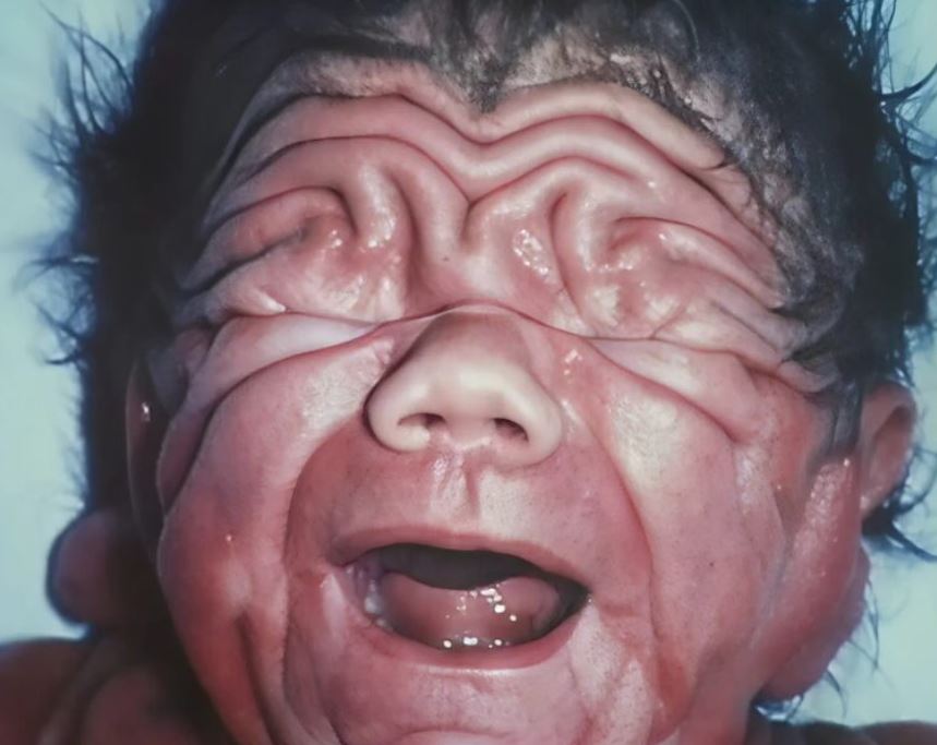 The story of the child who challenged doctors for 20 years with his rare disorder, here’s what he looks like as an adult.