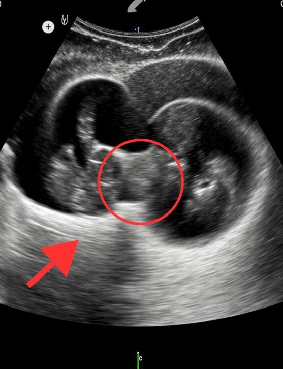 During my twin pregnancy ultrasound, the doctor froze, staring at the screen. Then he quietly said something that sent chills down my spine — words that changed everything.