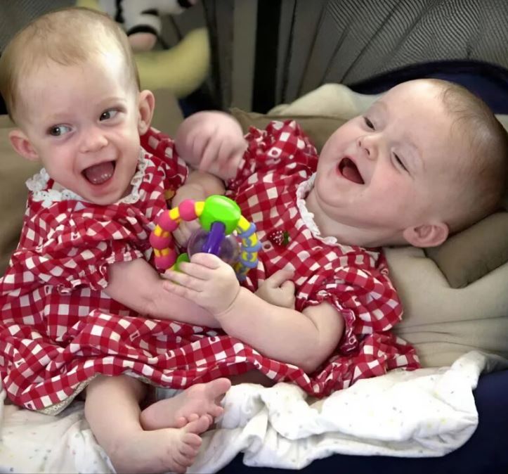 Doctors separated conjoined twins born connected at the chest: Here’s what they look like 25 years later