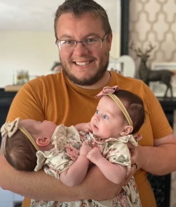 Siamese twins separated after complicated, hours-long surgery ։ See what they look like 3 years later