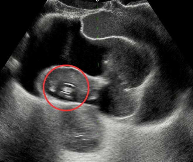 For a month, constant stomach pain had been disrupting my day. Feeling worse and worse, I finally went to see a doctor. His unexpected diagnosis left me speechless and completely shocked.