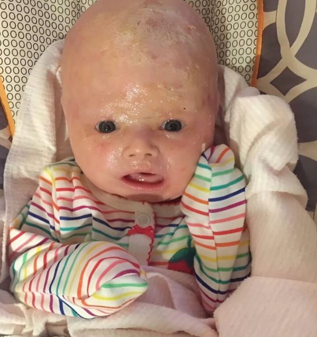 Doctors perform an emergency cesarean section and deliver a baby with a rare skin condition. Here is what he looks like as an adult.