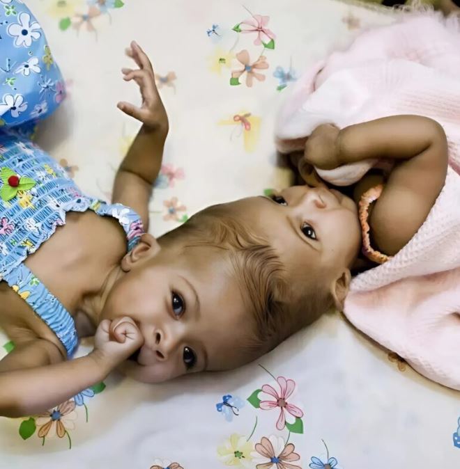 Conjoined twins were born in August, joined at the head in a rare condition called craniopagus. Their brains shared tissue, making their bond extraordinary and posing immense medical challenges from the start.