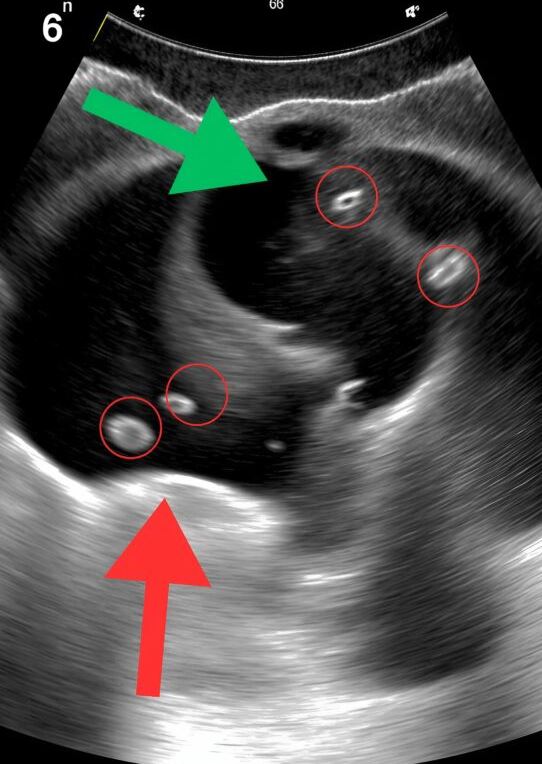 I was doubled over with unbearable abdominal pain and constant vomiting. At the hospital, the doctor calmly said we must operate immediately. The diagnosis behind his words stunned me completely.