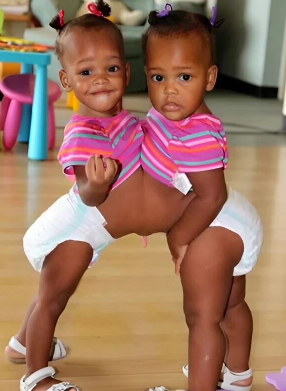 María and Teresa Tapia were literally inseparable, born conjoined at the chest. After a complex and risky operation, doctors achieved the impossible — they successfully gave each girl her own independent life.