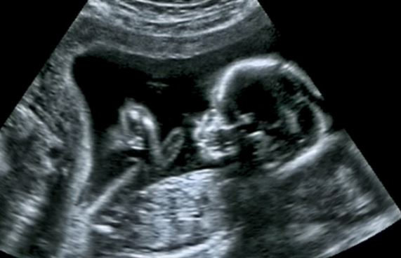 Scientists May Have Actually Found One Of The Causes Of Autism