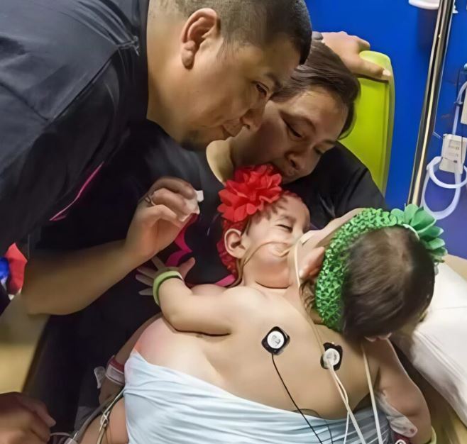Conjoined twins who shared a digestive system were separated after a nine-hour surgery. Here’s what they look like.