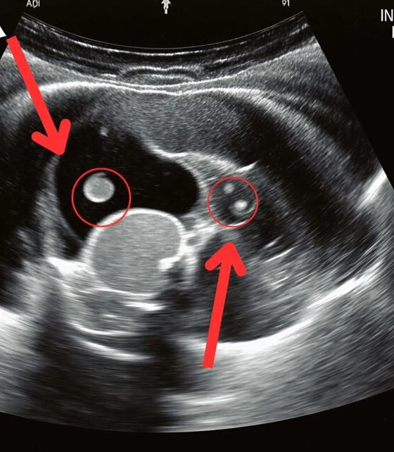 After school my daughter cried, “Mom, my stomach hurts, I can’t sit or walk.” At the hospital, the doctor looked serious and said, “We must operate immediately.”