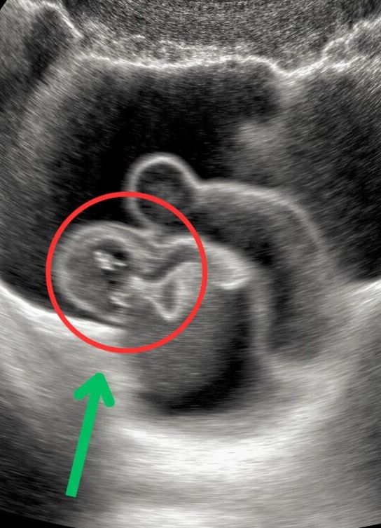 I was six months pregnant when the doctor froze, staring at the ultrasound screen. His sudden silence sent chills down my spine, and the words he finally spoke filled me with fear and uncertainty.