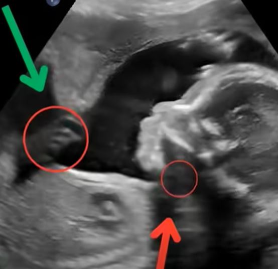 We were joyfully awaiting our second child when the doctor’s words shattered our world. In one quiet room, hope turned into fear, and our future suddenly felt uncertain, fragile, and painfully real.