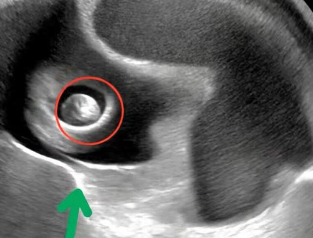 I had asked my neighbor to watch my daughter for just twenty minutes while I did my chores… but when I got home, I found Lily screaming from stomach pains. The doctor at the hospital was shocked.