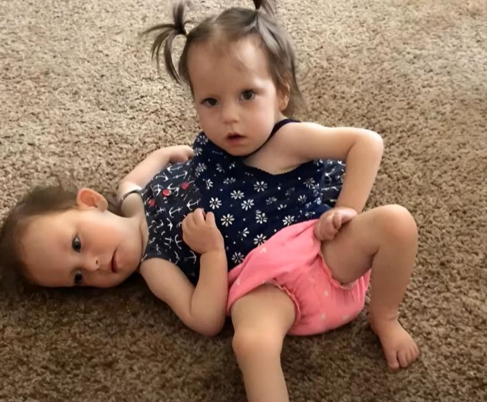 Photos of the girls before and after the separation of the Siamese twins shock everyone.