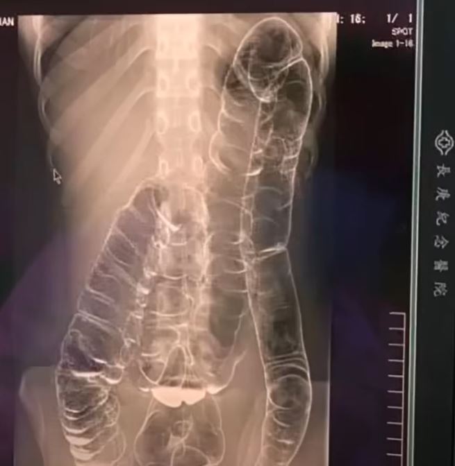 Everything you need to know about chronic constipation: A hidden threat to your digestive health