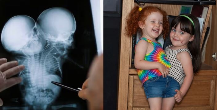 The conjoined twin girls were successfully separated with the help of doctors, but years later their new appearance and unexpected reality amaze everyone