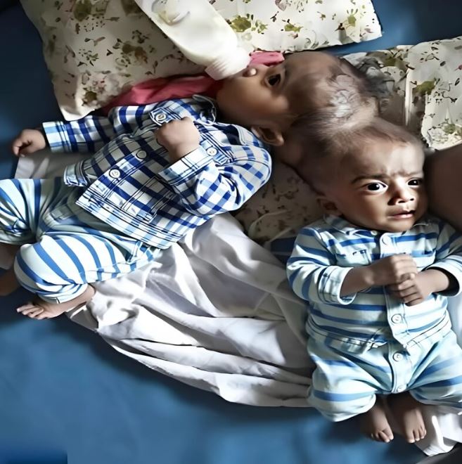 16 doctors worked together to separate the children, here is how they are years later